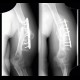 Hardware failure, osteosynthesis, deformity, fracture of humerus: X-ray - Plain radiograph